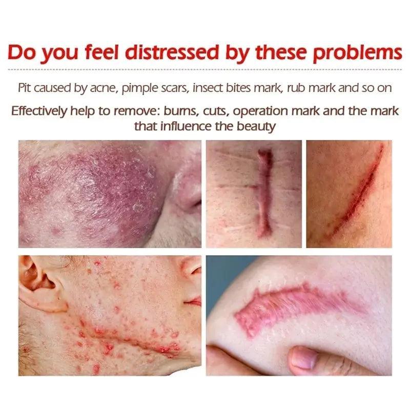 New Herbal Scar Repair Cream - BelleHarris
